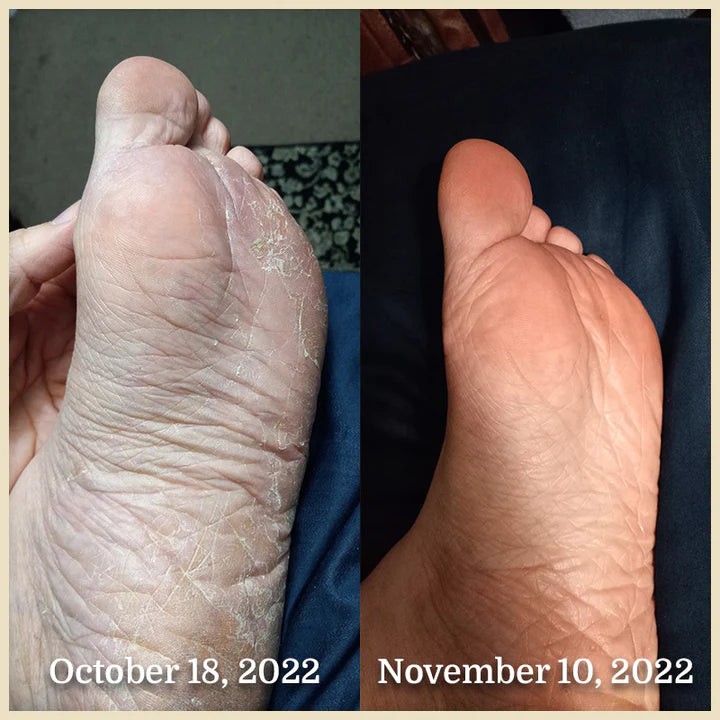 Grass Fed Beef Tallow Skin Care Moisturizer Lotion Miracle Tallow grass-fed-beef-tallow-skin-care-moisturizer-lotion-miracle-tallow