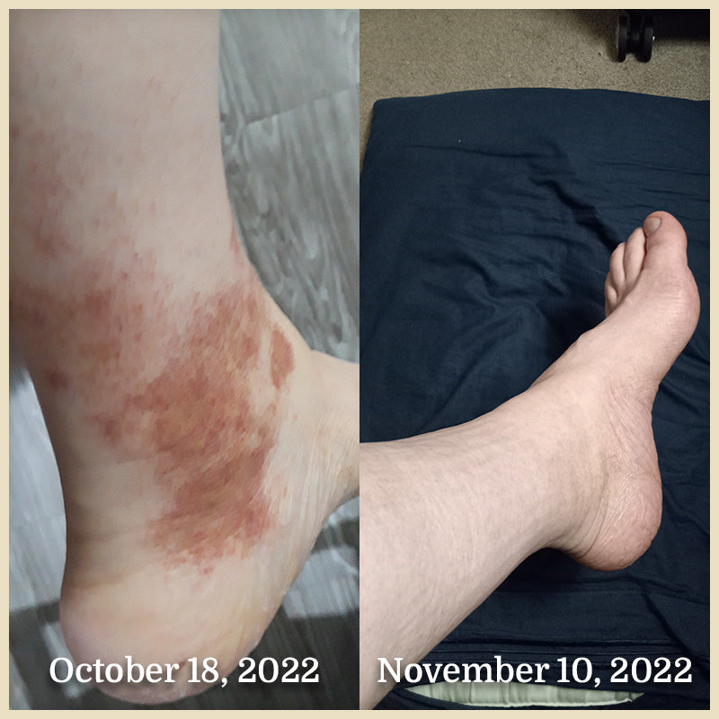 Beef Tallow Cream And Balm For Eczema Beef Tallow For Stretch Marks beef-tallow-cream-and-balm-for-eczema-beef-tallow-for-stretch-marks